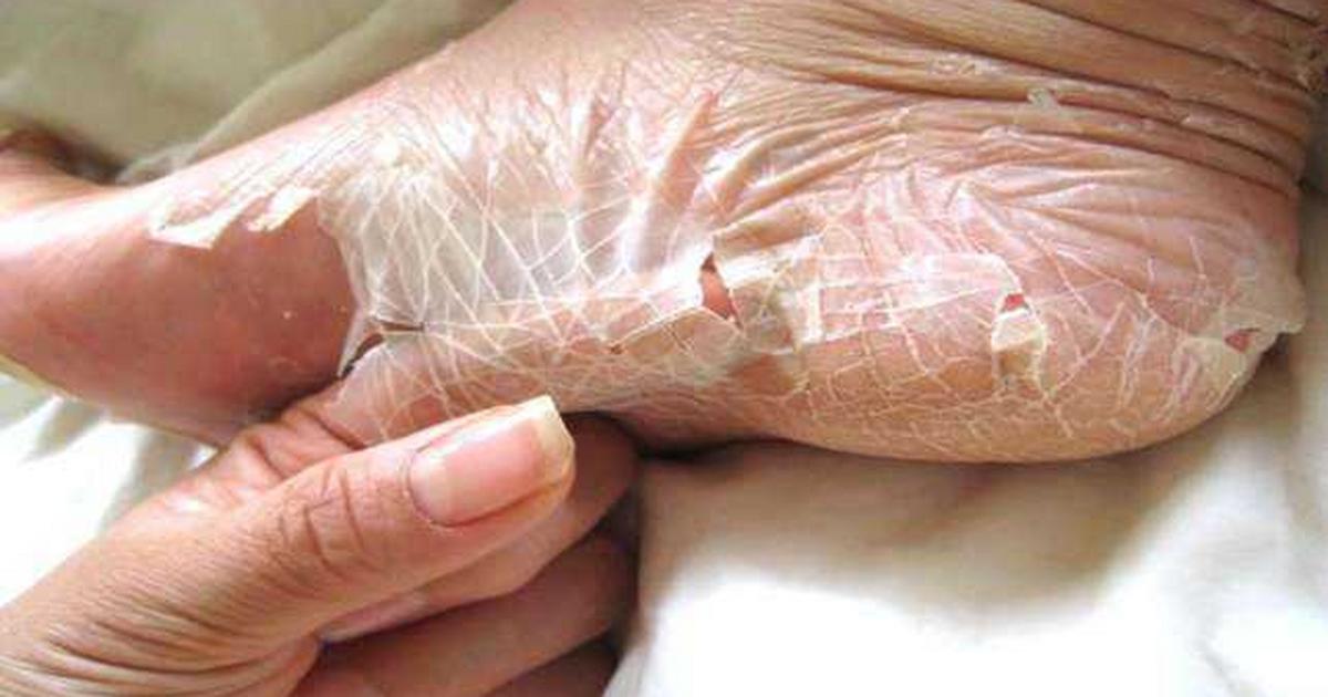peeling skin: Here are the possible causes and home remedies for this  condition | Pulse Nigeria